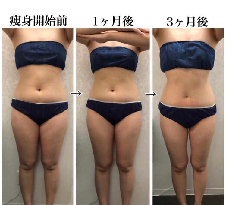 脂肪冷却